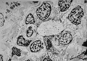 M,17y. | liver cirrhosis